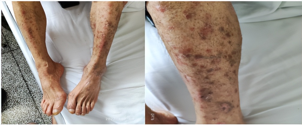 常见梅毒有哪些,病毒性梅毒症状有哪些