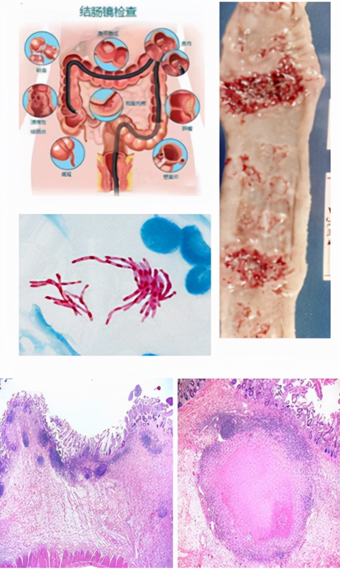 肺结核会传染给别人得肠结核吗,治疗肺结核的同时治疗肠结核吗