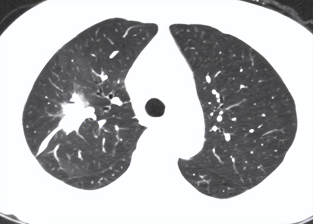 75岁老人肺癌治疗会不会很痛苦,75岁老人肺癌扩散腰疼