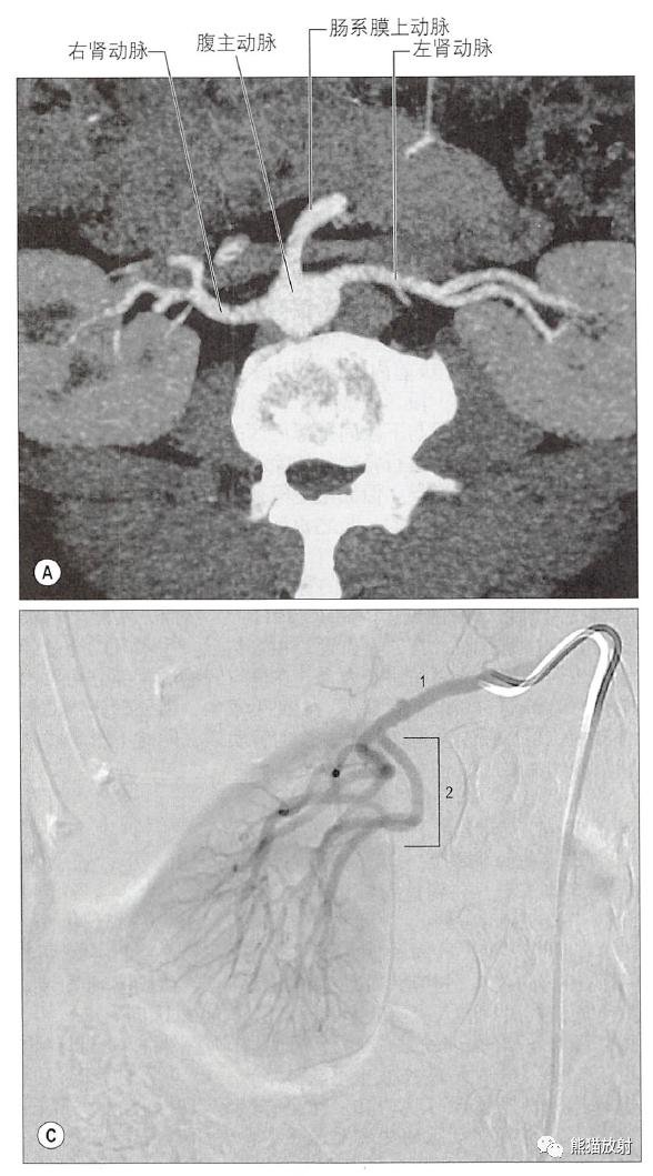 输尿管和髂血管解剖,脾胰解剖图