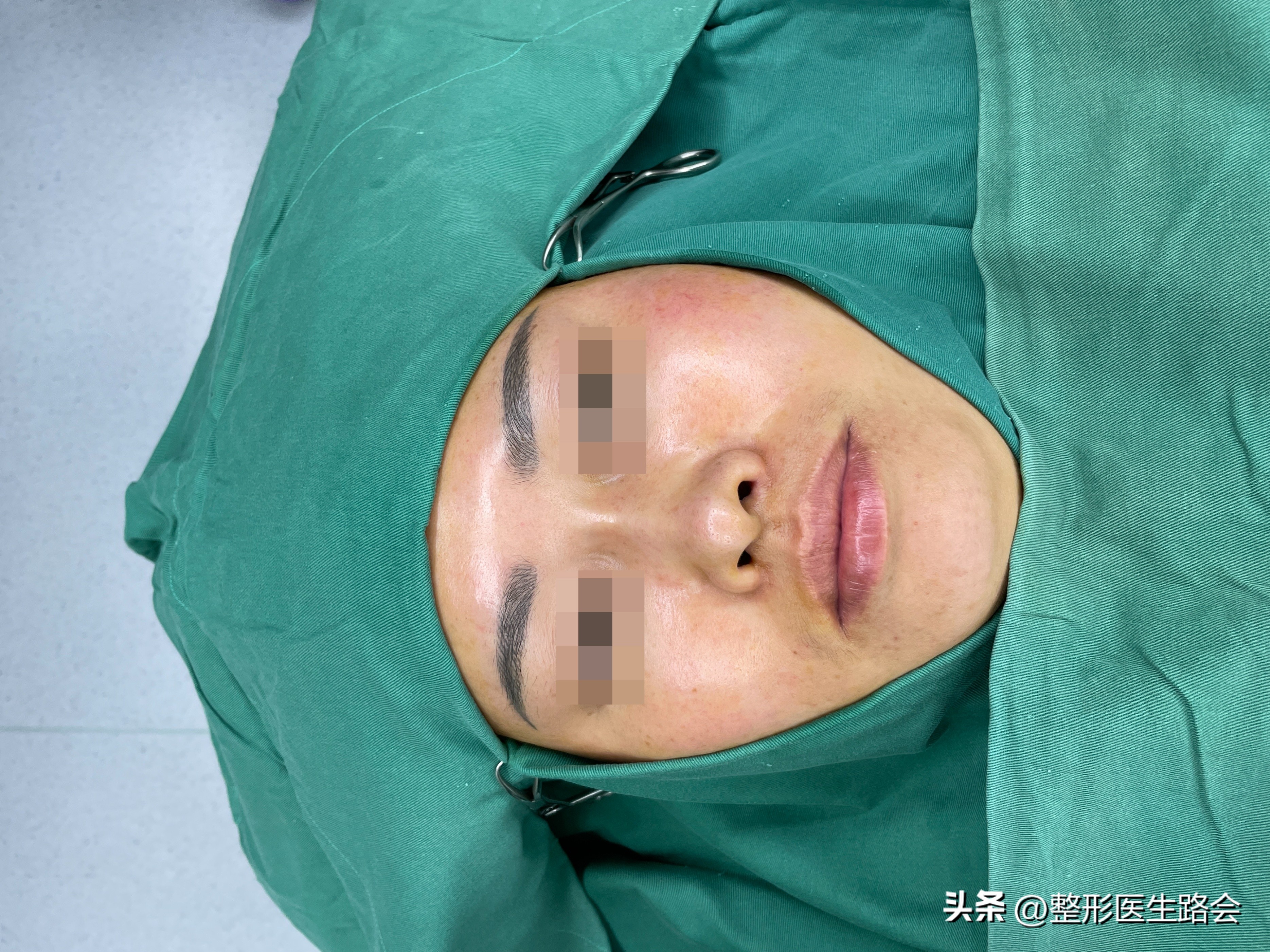 线雕鼻修复成超肋隆鼻,线雕隆鼻能解决鼻基底凹陷吗