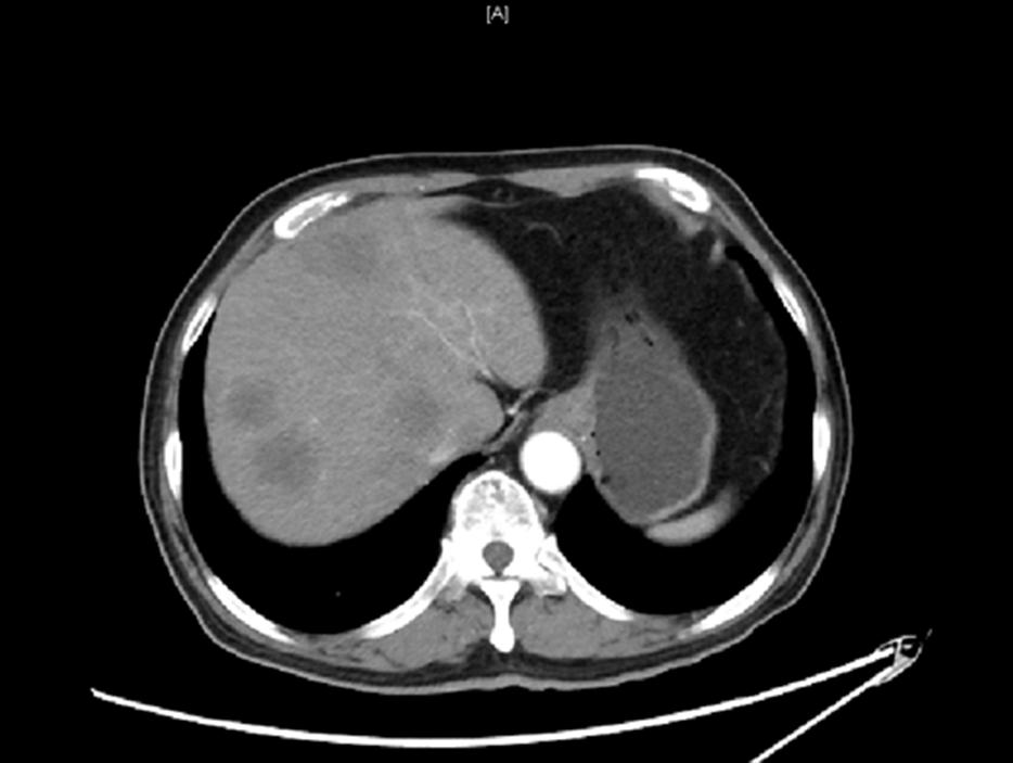 her2阳性乳腺癌2期治愈率,her2阳性乳腺癌新辅助治疗方案