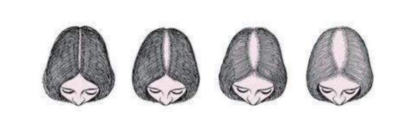 脂溢性脱发应该如何改善,脂溢性脱发怎么有效改善