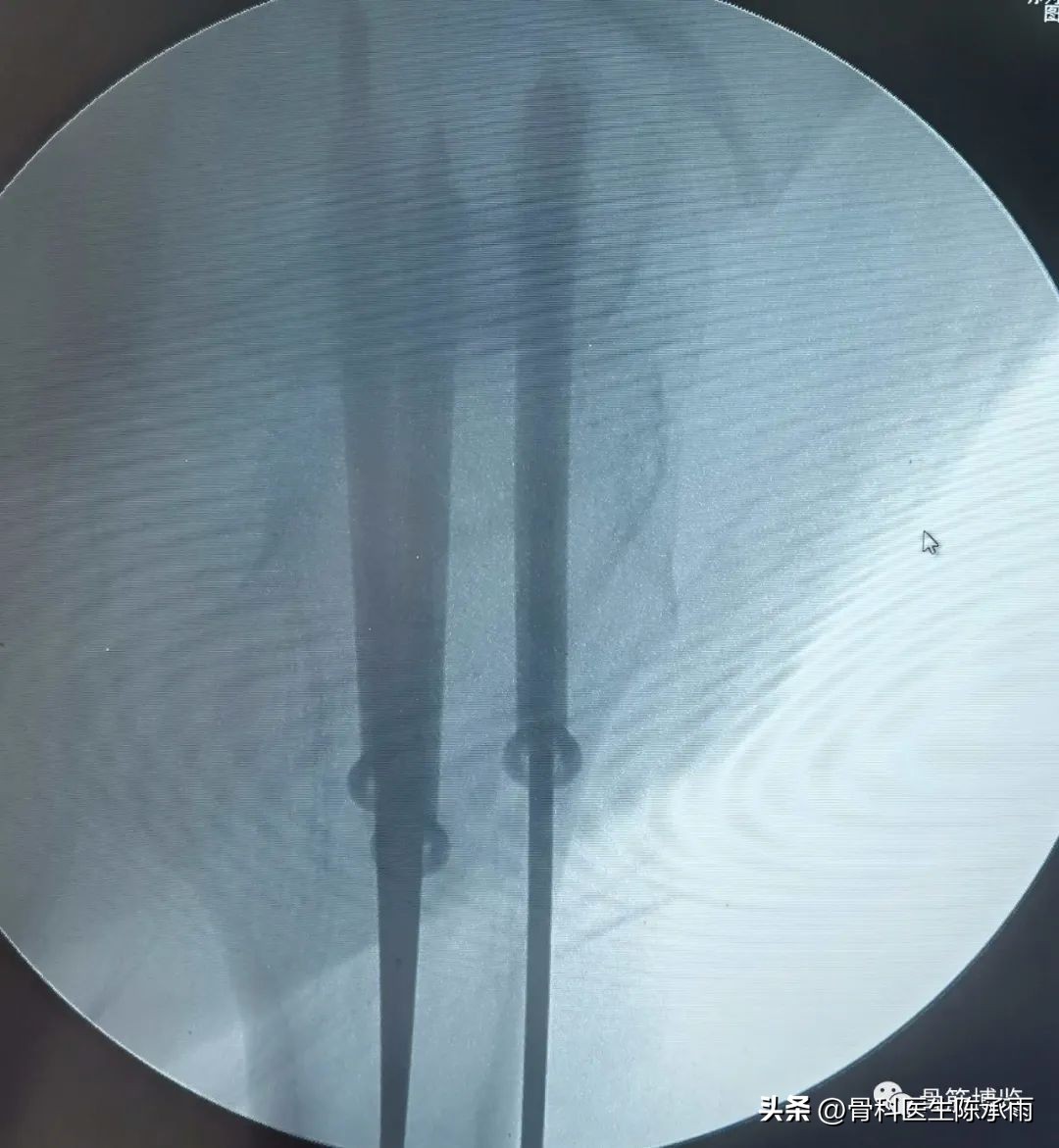 股骨颈闭合复位内固定术后护理,股骨颈骨折闭合复位的技巧