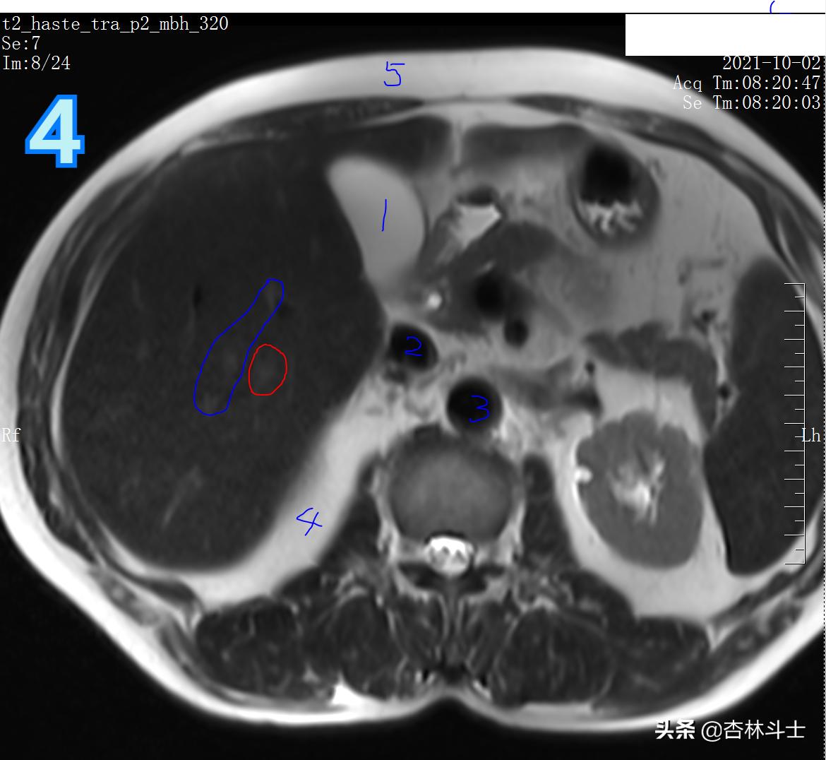 肝癌8公分肿瘤能活多久,肝癌细胞最大长多大