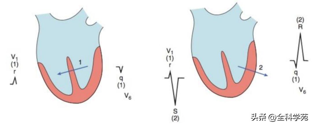 心电图笔记26：QRS波振幅变高，需要想到哪些