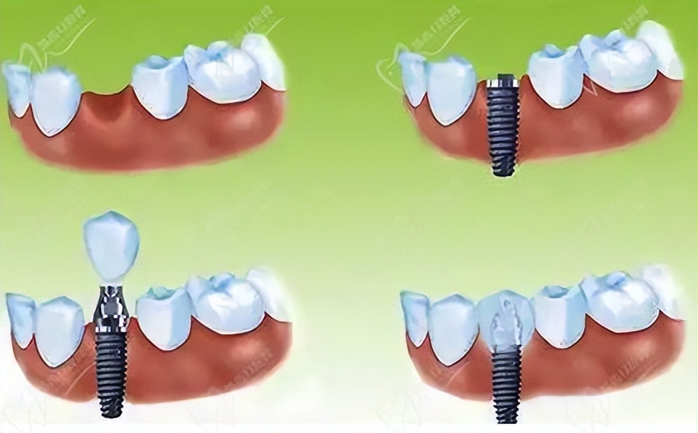 襄阳种植牙最好医院,襄阳哪里可以学习种植牙