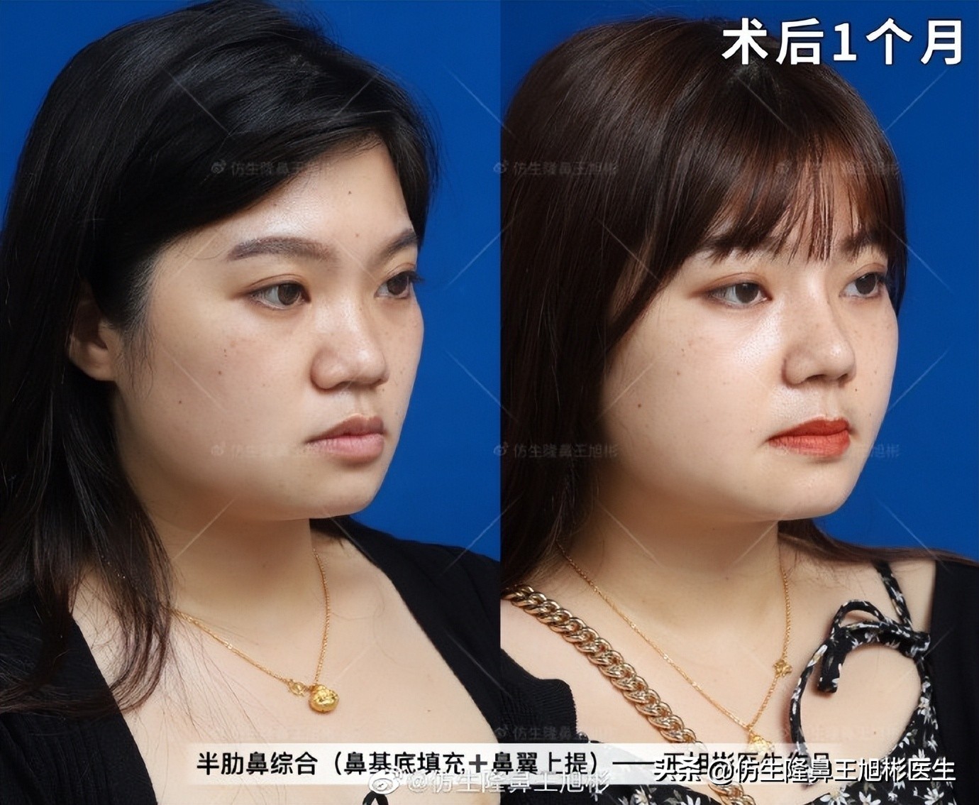 鼻整形后鼻头大,鼻整形后脸小了