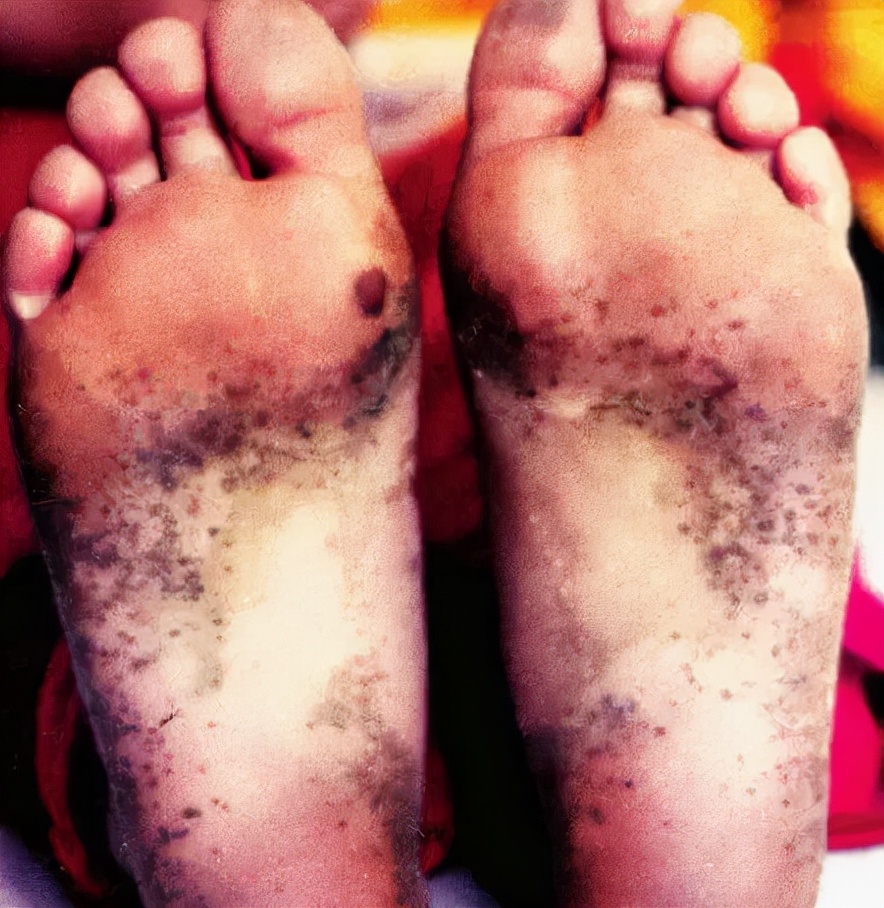 为什么长筒靴脚踝处容易摩擦,长期穿靴子脚会怎么样