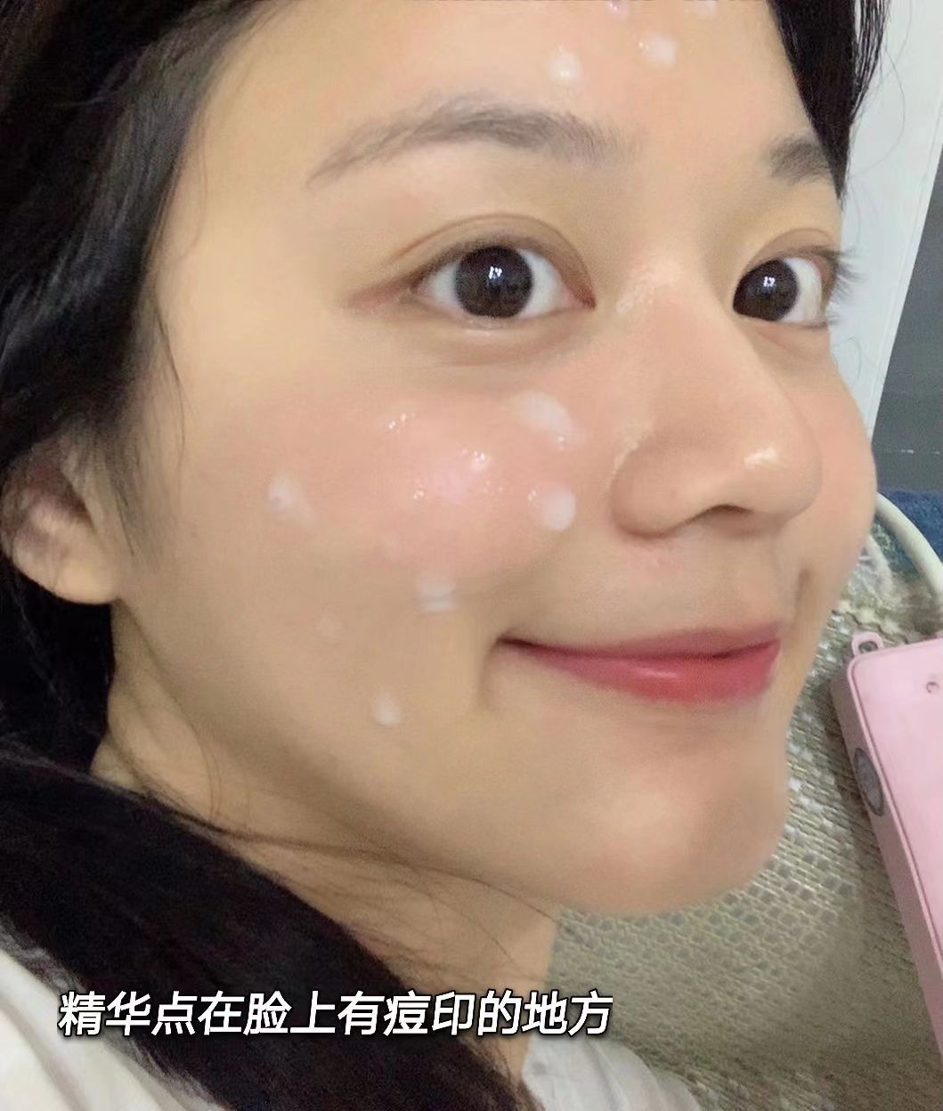 如何祛痘印最有效简单方法,皮肤科推荐淡化痘印收缩毛孔