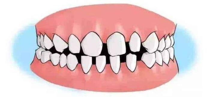 牙缝大怎么补,牙缝大对牙齿危害最小的修复方法