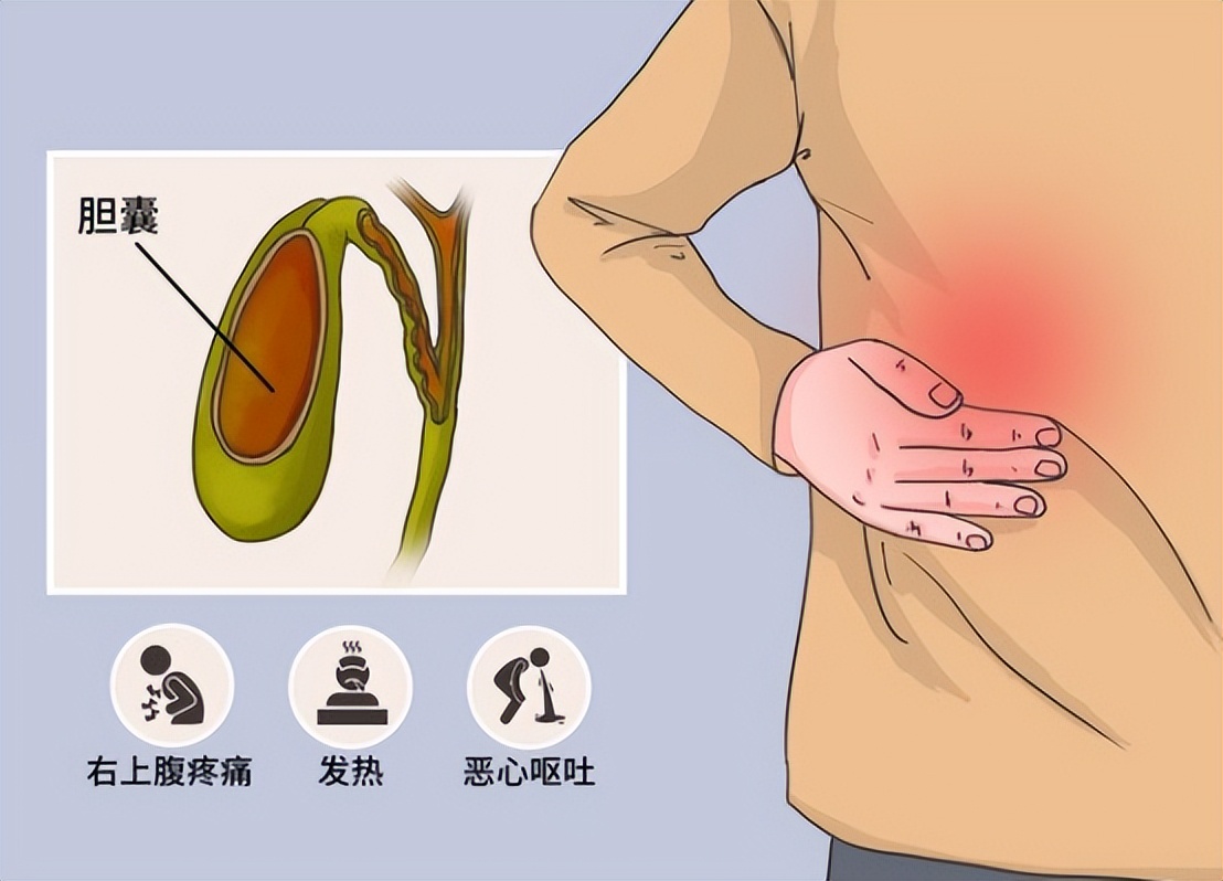 急性胆囊炎的主要治疗方法有哪些,急性胆囊炎最佳的治疗方案是什么