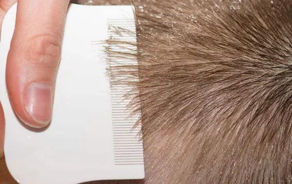 小时候头上长虱子的事,小时候头上的虱子是什么样子的