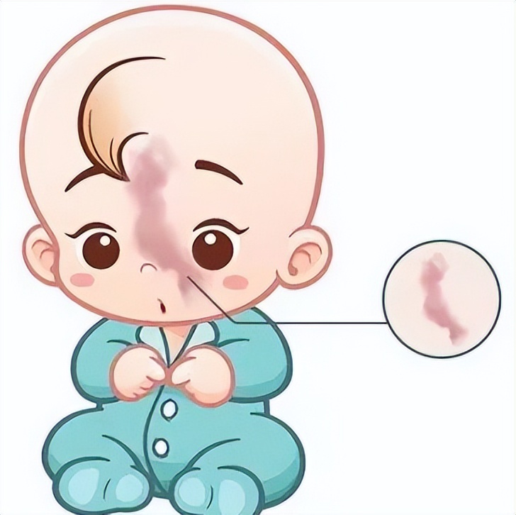 新生儿有胎记,新生儿身上有胎记怎么处理