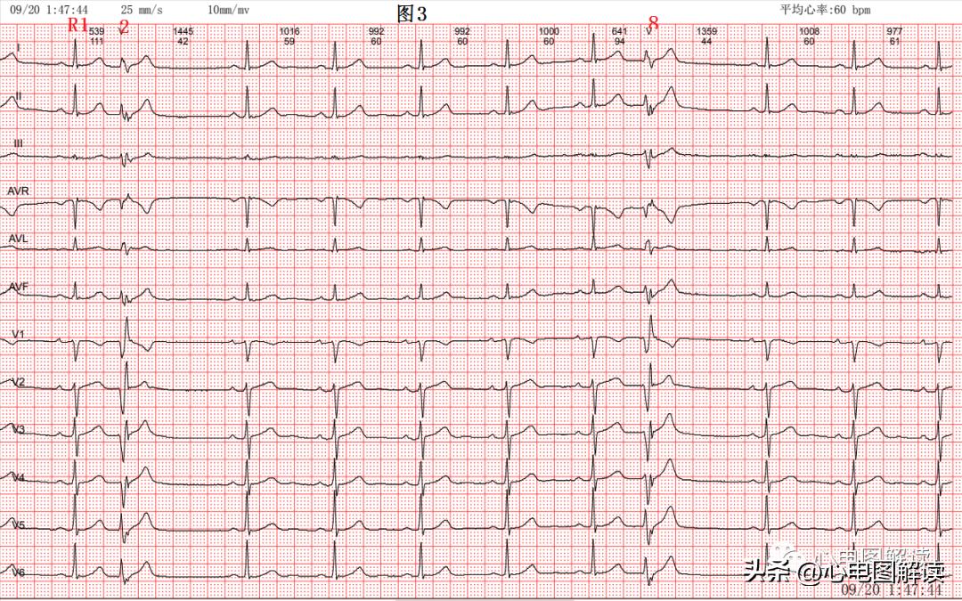 房早和室早怎么分辨,房早和室早的鉴别要点