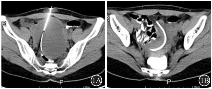 巧克力囊肿超导介入手术,介入治疗巧克力囊肿11公分