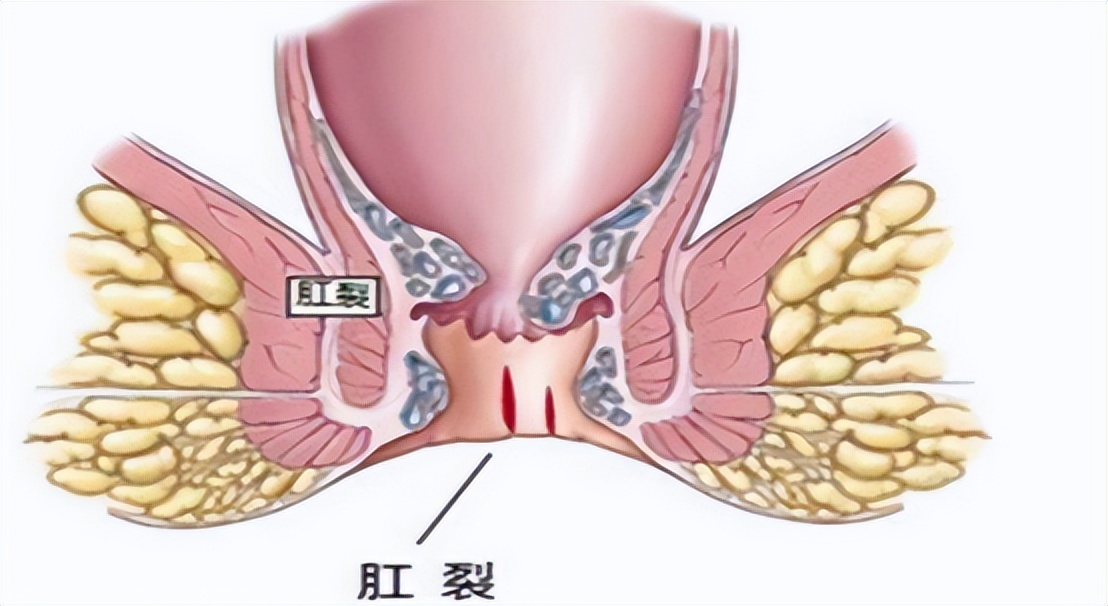 警惕肛裂带来的危害,肛裂为什么以年轻女性为主
