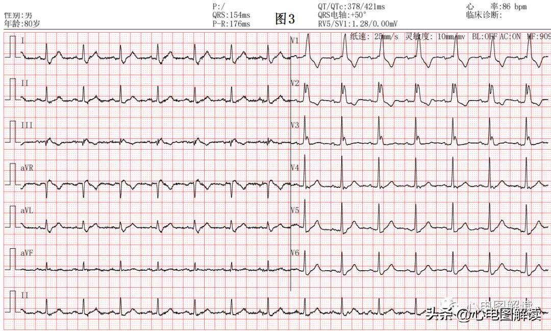 完全性右束支阻滞有什么症状吗,完全性右束支传导阻滞的中成药