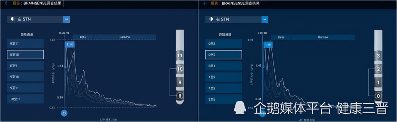智能可感知脑起搏器植入手术,山西省首例机器人植入脑起搏器