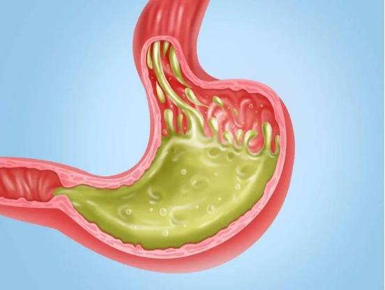 胃食管反酸烧心怎么治,总烧心胃反酸吃什么药