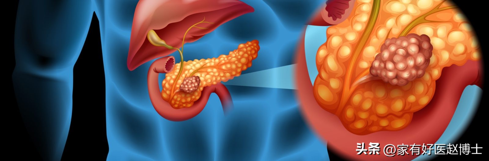 发现糖尿病怎么治疗,如果出现糖尿病前兆应该怎么控制