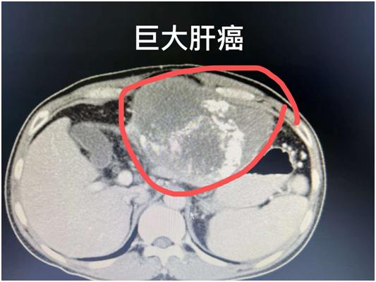 介入治疗原发性巨型肝癌有效吗,巨型肝癌介入加靶向药