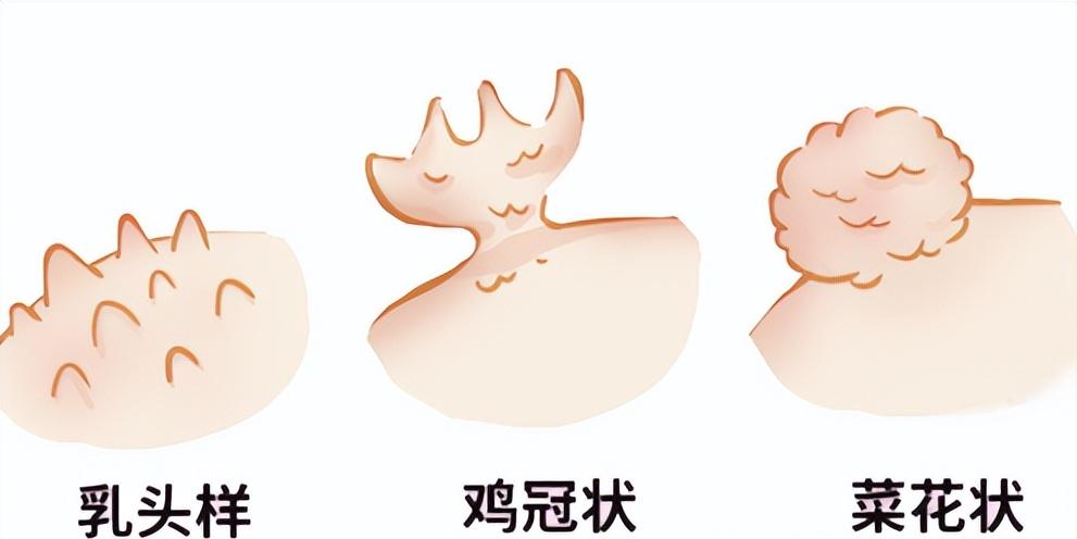 尖锐性湿疣治疗过后还有小疙瘩,尖锐性湿疣治疗过后还有白点