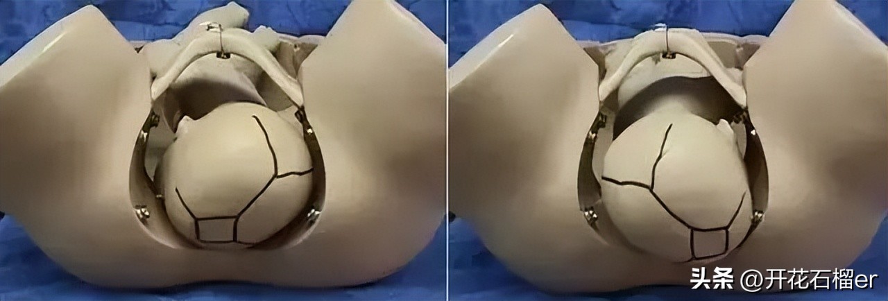 胎儿在几个月容易缺氧,胎儿一般在几个月容易停胎