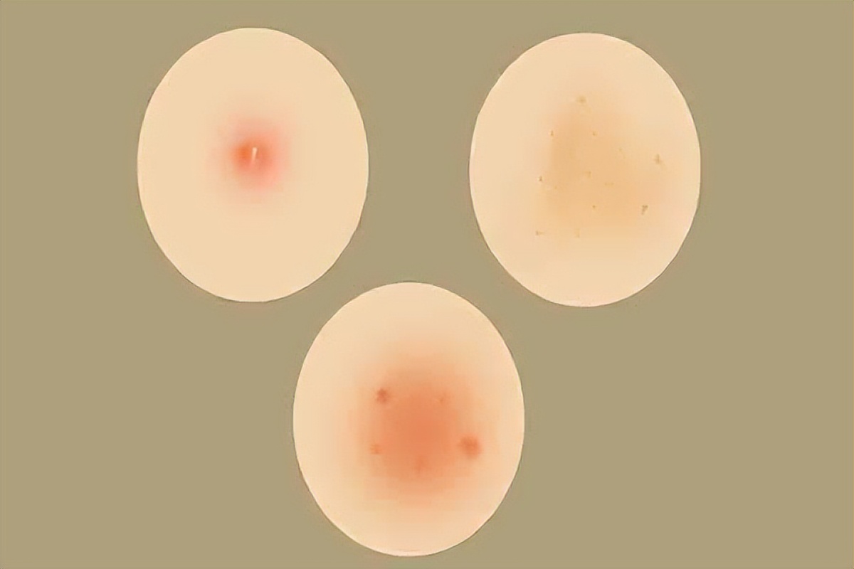 皮炎湿疹和通常说的湿疹一回事吗,湿疹反复发作打不了预防针怎么办