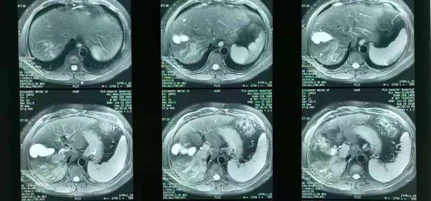 放疗肝内胆管细胞癌能治好吗,放疗治疗肝门静脉癌栓