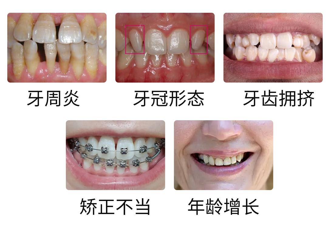 蛀牙引起的黑三角怎么治,牙齿黑三角处蛀牙怎么办