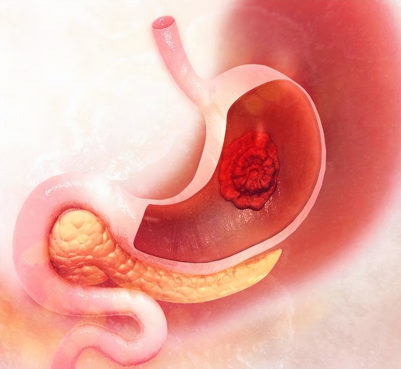 萎缩性胃炎c3伴肠化就是胃癌吗,萎缩性胃炎肠化转胃癌几率高不高