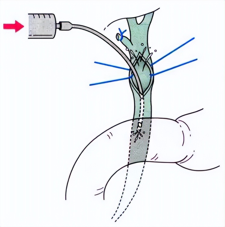 胆总管切开术后留置t型管,胆总管切开术中造影