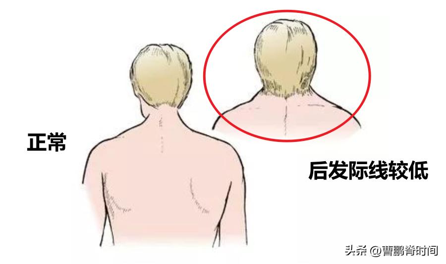 脖子两侧筋痛要警惕三种疾病,天生短脖子怎么改善