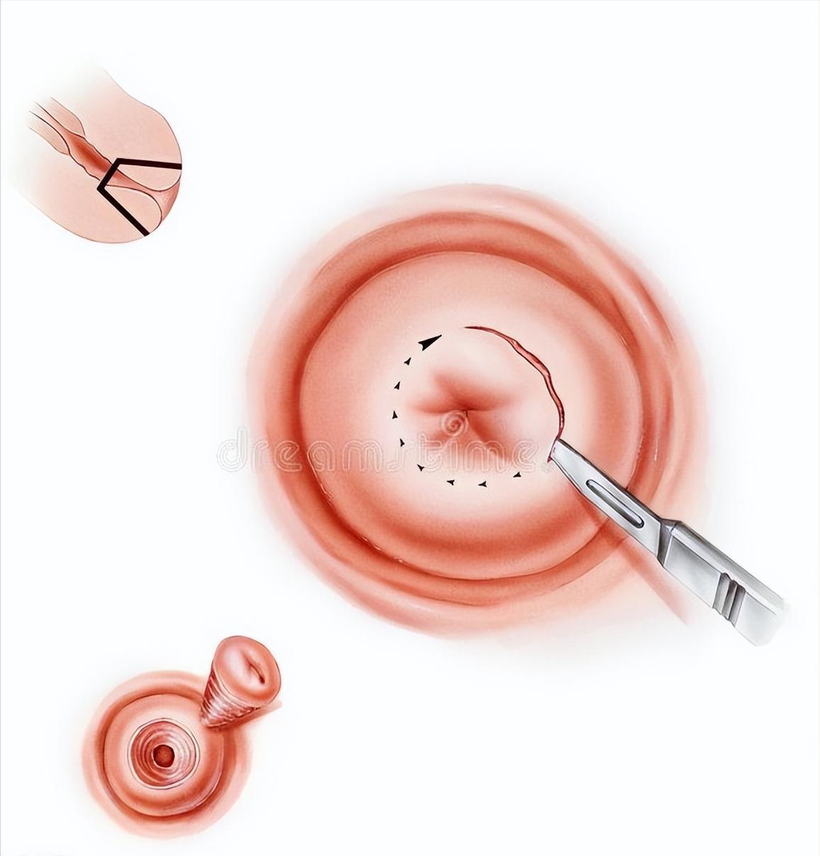 派特灵和派特舒尔一起怎么使用,派特灵伊可尔派特门诊是什么