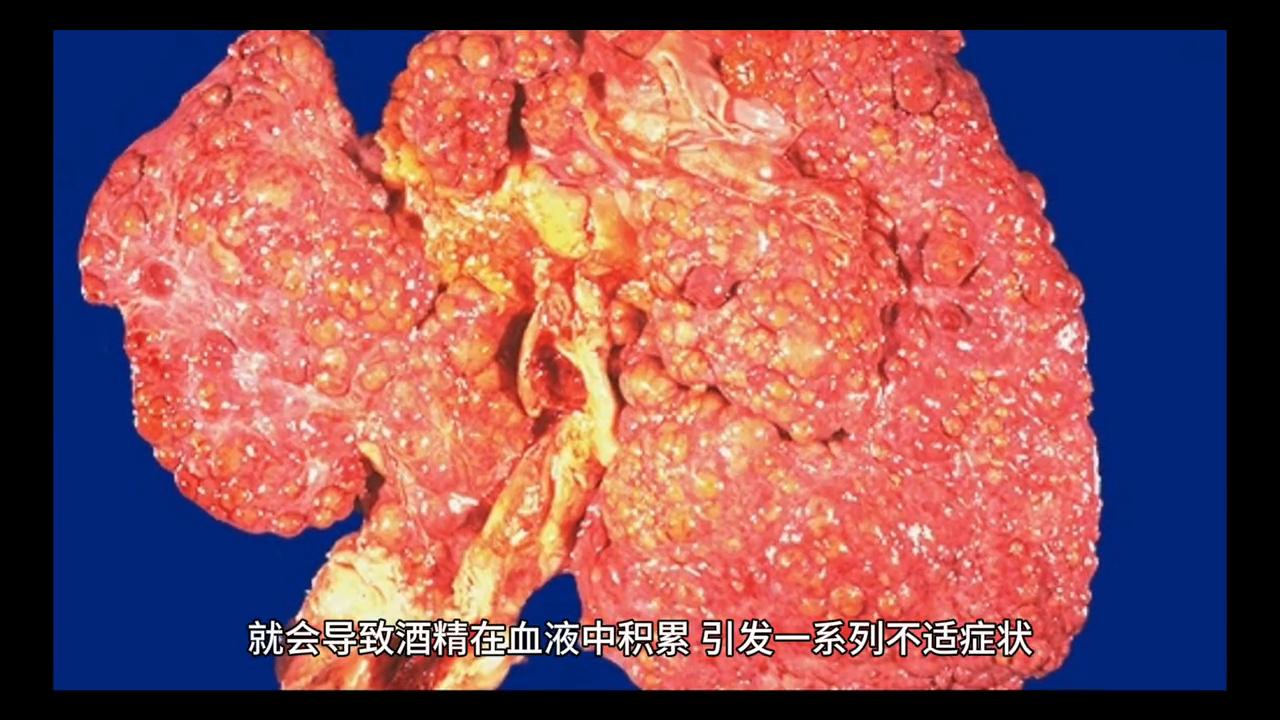 如何缓解酒后不适症状,如何缓解酒后胃部不适