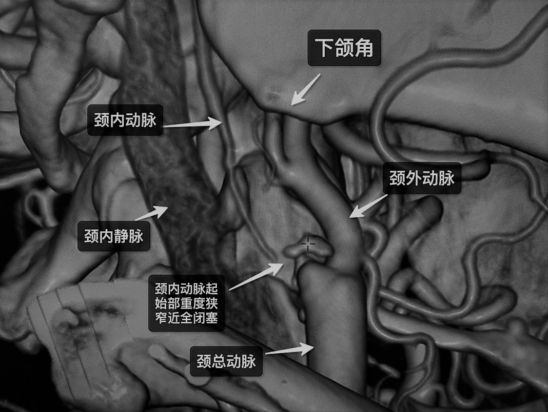 颈动脉狭窄迷糊怎么治疗,左手不听使唤