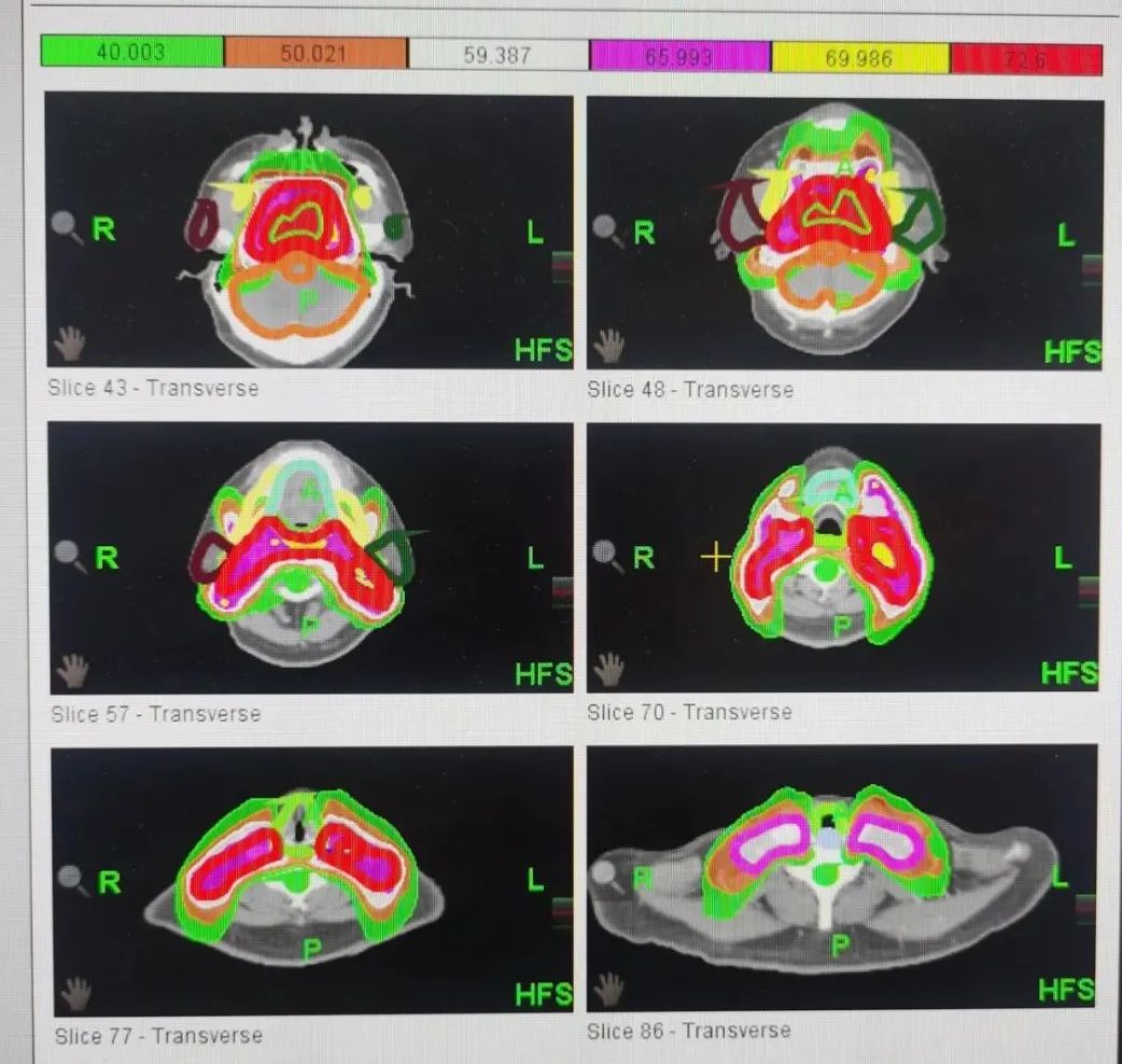 鼻咽癌精准放疗质子治疗费用,鼻咽癌首选放疗还是化疗