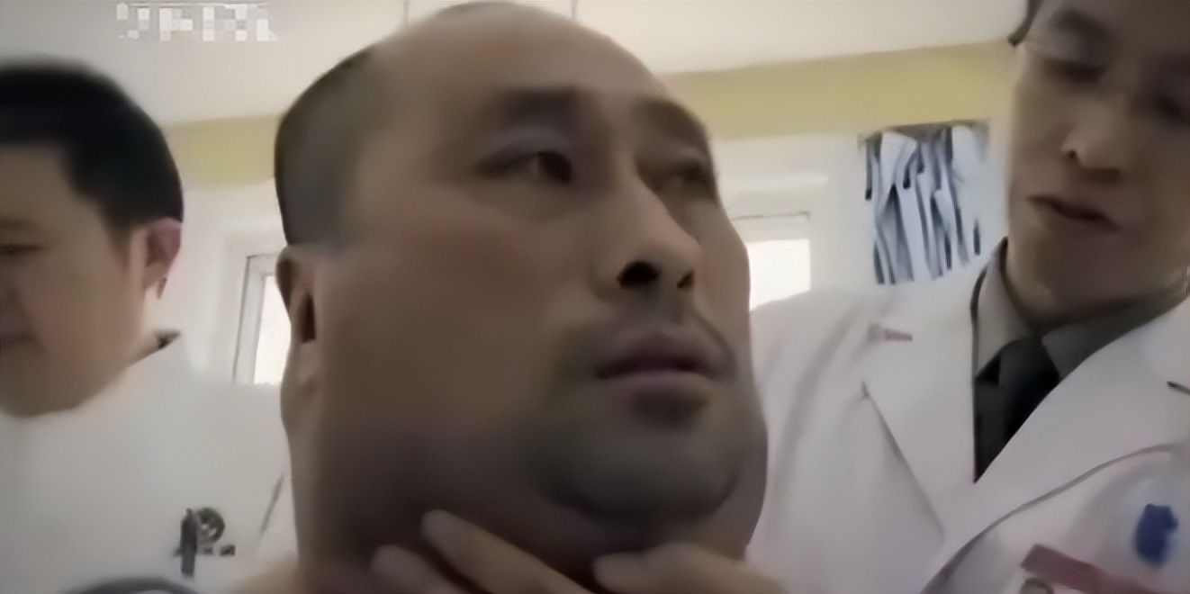 62岁大叔喝出河马脖,辽宁男子喝酒成河马