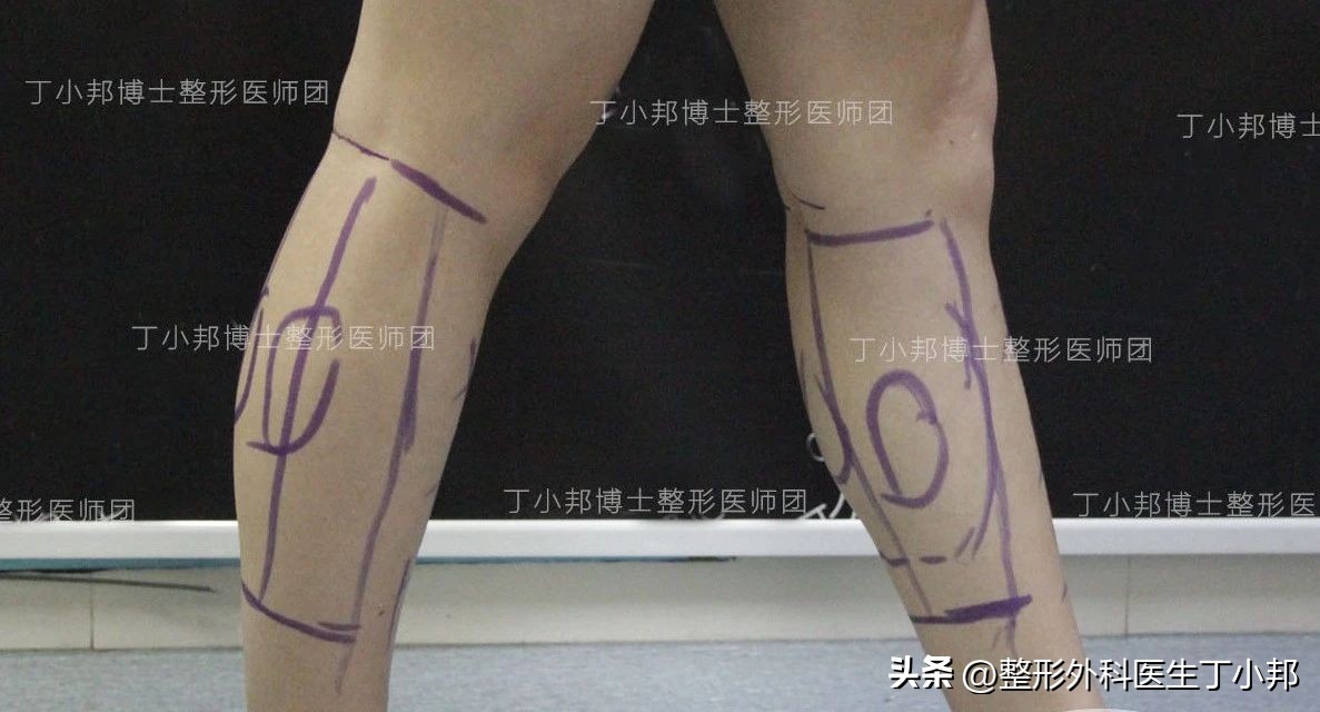 什么人不能做小腿吸脂手术,整形医生总结吸脂瘦腿