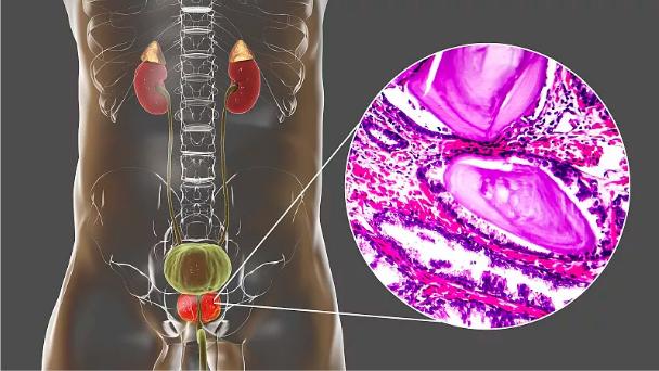 神奇的粒子—前列腺癌患者纷纷点赞的125I粒，术后三天即可出院。