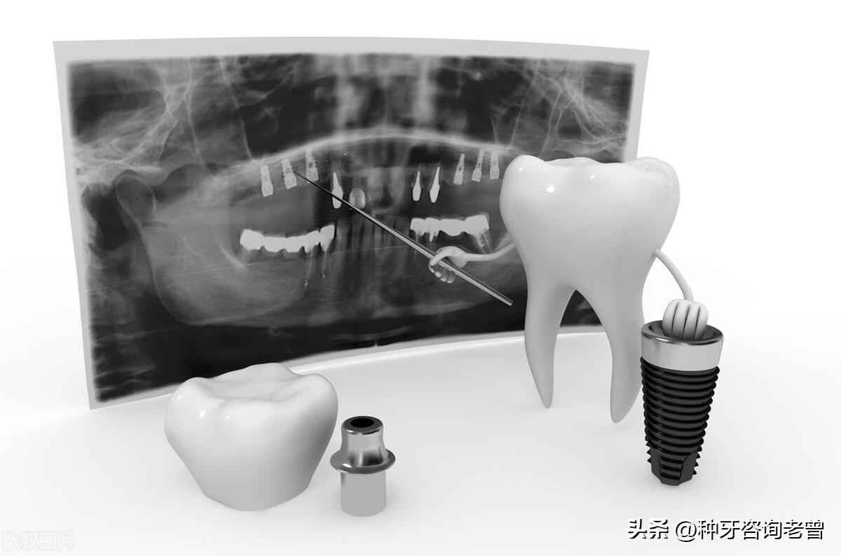 种植牙需要注意哪些坑,种植牙如何避免踩坑