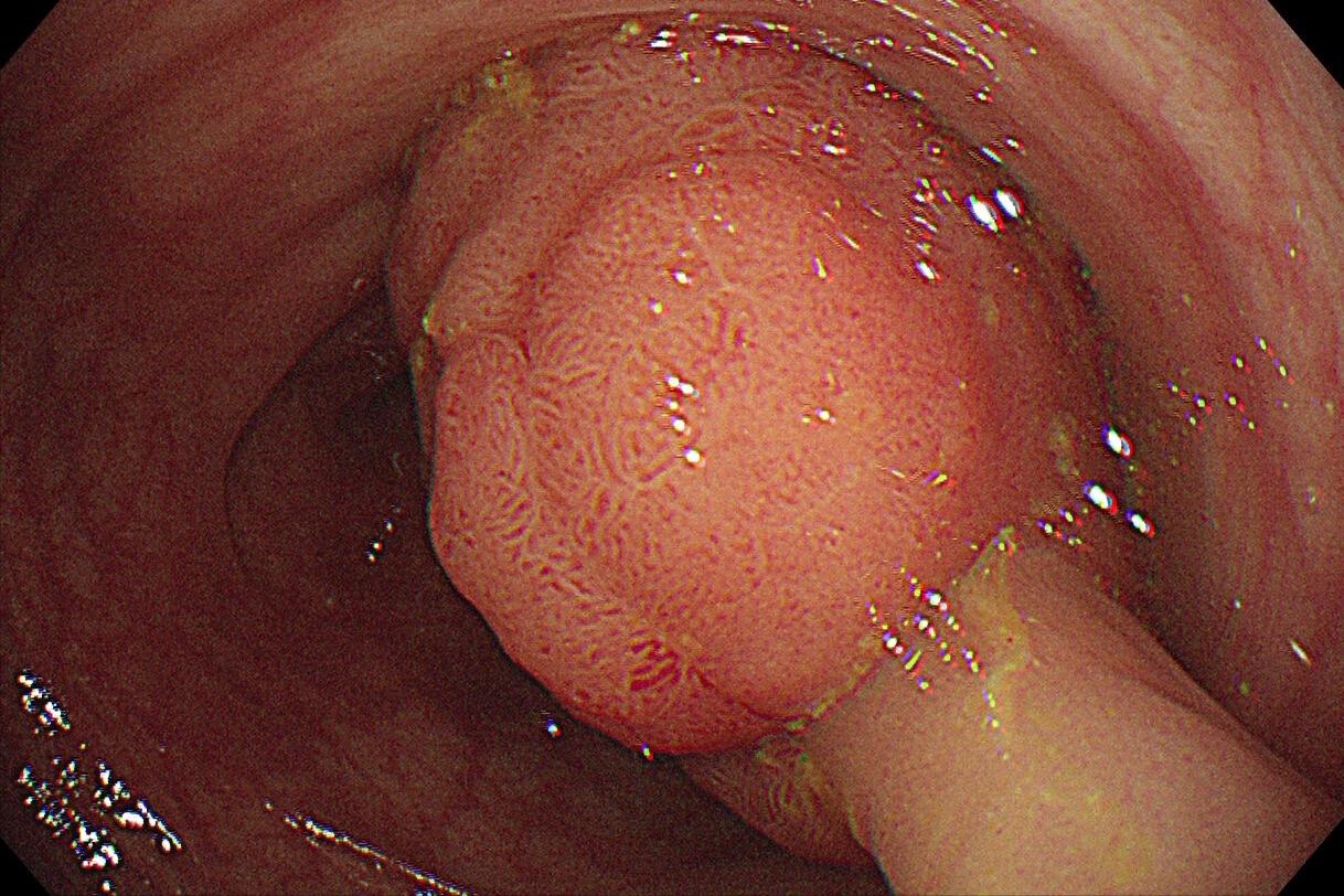 为什么肠道老是长息肉,肠道长息肉怎么分辨严重或不严重