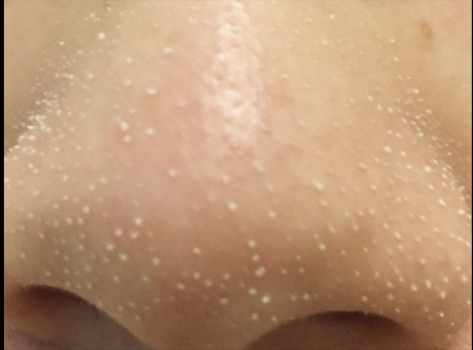 鼻子毛孔小黑头出不来怎么办,小女孩鼻子有黑头毛孔粗怎么办