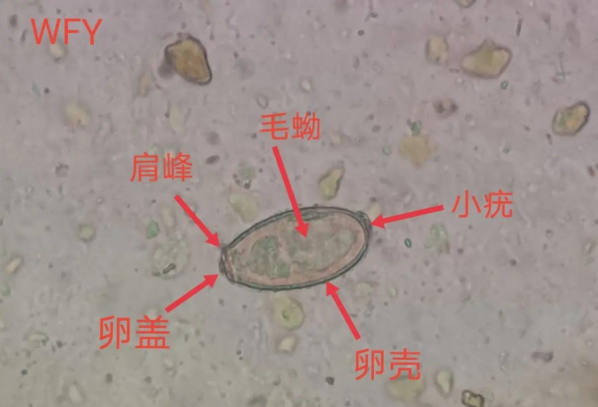 22岁少女体内有寄生虫,20岁女孩腹部有寄生虫