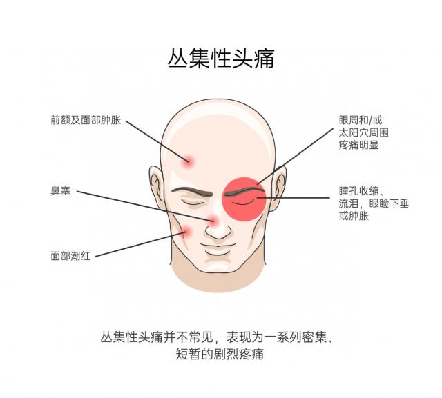 为你分析10大头痛类型,你的头痛是第几种?