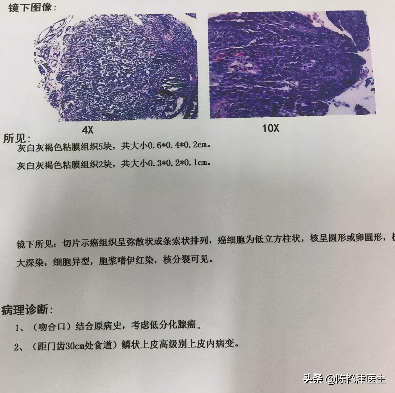胃癌最大的祸根是幽门螺杆菌，想要彻底杀菌，记住3个办法