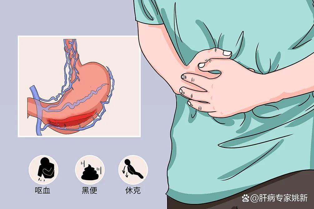 治肝硬化肝病最好的中医,肝硬化喝中药活血化瘀的表现
