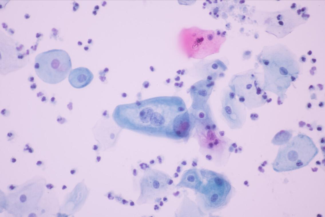 派特生物派特灵治疗hpv有效果吗,派特生物怎么治疗hpv高危型
