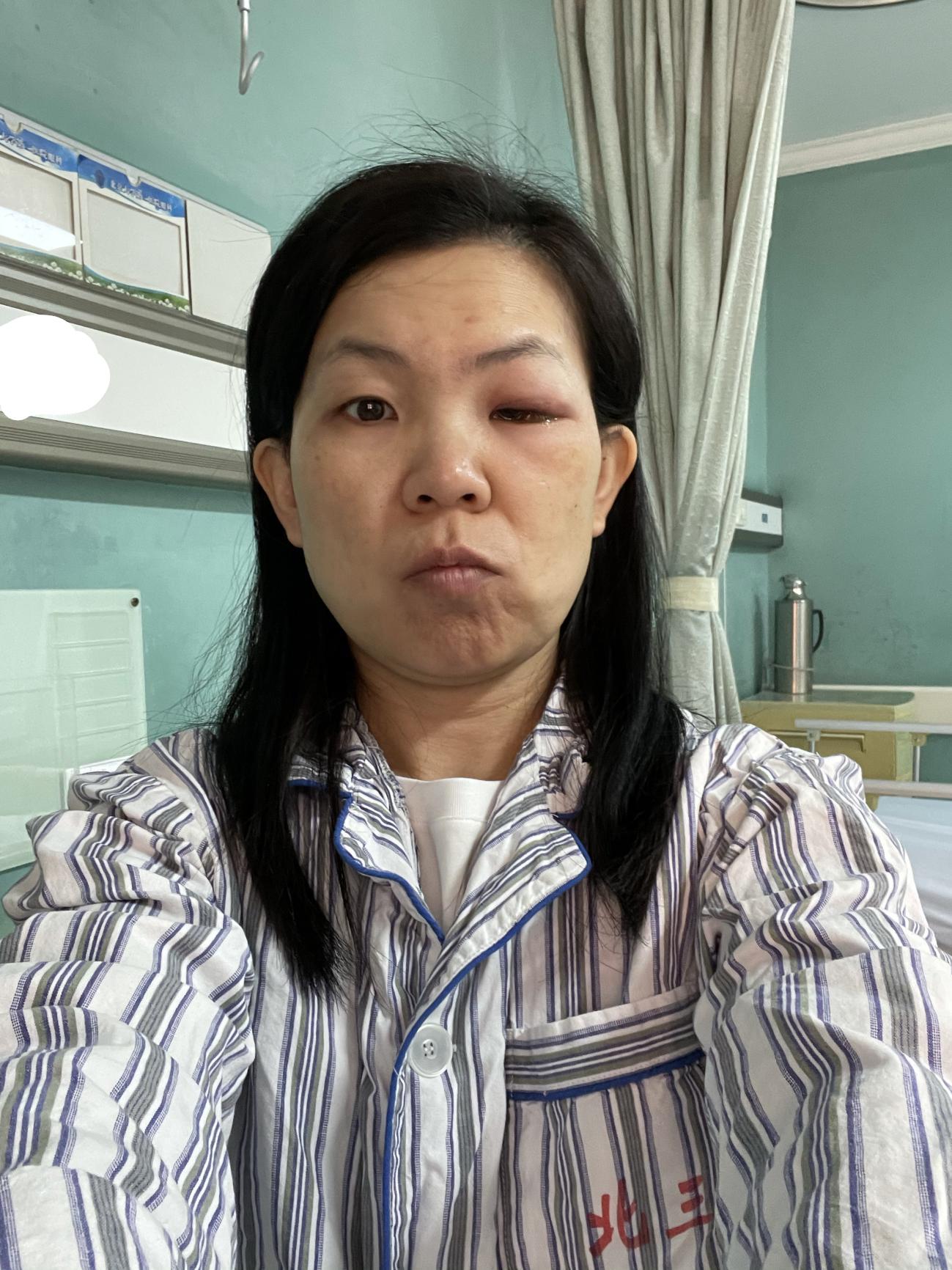 眼眶蜂窝织炎看病经验分享,患了急性眼眶蜂窝织炎如何治疗